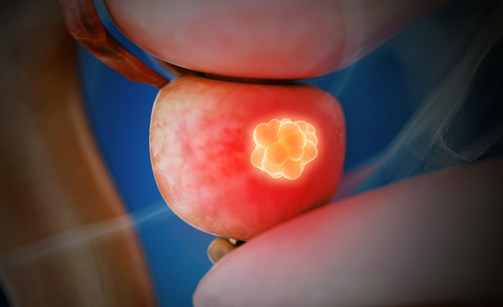 Brachytherapy
