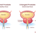 Diagram showing normal vs enlarged prostate affecting urine flow (BPH)